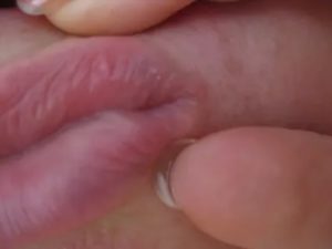 Уплотнение между половых губ