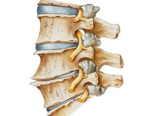 Остеофиты на позвоночнике
