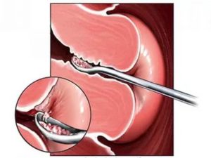После удаления полипа эндометрия
