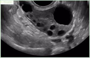 Мультифолликулярные яичники, нет овуляции