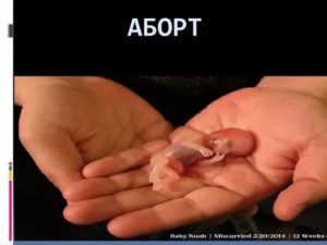 Можно ли зделать аборт на сроке 12 недель