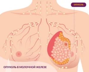 Опухоль молочной железы