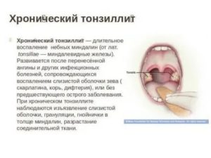 Пробки в миндалинах при беременности