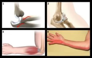 Боль при сгибании и разгибании руки