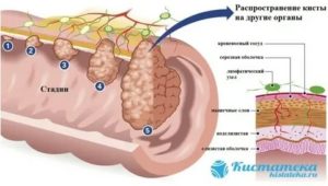 Кисты на разных органах