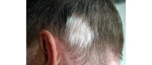 Белый клок волос на голове
