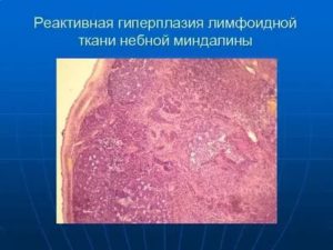 Гиперплазия элементов лимфоидной ткани, увеличенные лимфоузлы