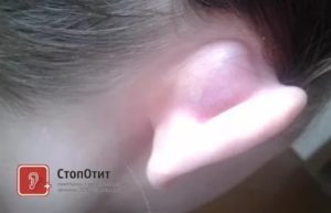Увеличена кость над ухом справа больше чем слева