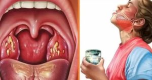 Может ли болеть язык по бокам при хроническом тонзиллофарингите
