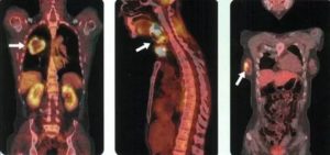 Результат ПЭТКТ солидное образование в легких что это?
