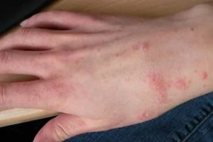 Аллергия с волдырем на метронидазол