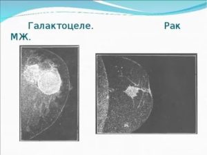 Фиброаденома? Галактоцеле?