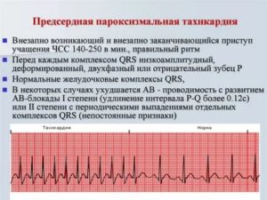 Тахикардия от тироксина, есть ли необходимость принимать постоянно