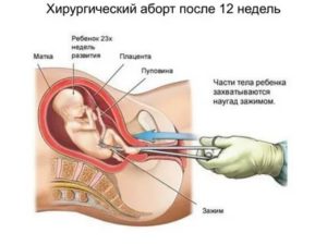 Можно ли зделать аборт на сроке 12 недель