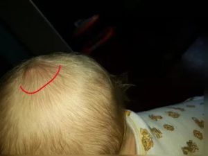 У ребёнка красное пятнышко на голове