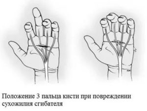 Травма сухожилия глубокого сгибателя, не разгибается палец