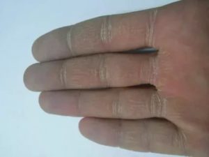 Трещины на руках при сухой экземе