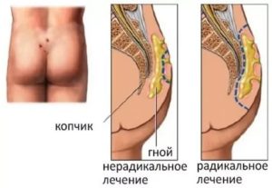 Боль после перевязки ягодицы по поводу абсцесса