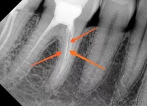 Сломан инструмент в корне зуба