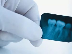 Анестезия и рентген зуба до задержки