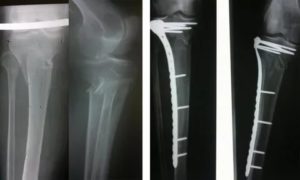 Реабилитация после перелома большой берцовой кости
