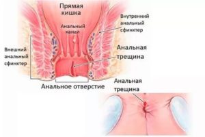 Трещина в заднем проходе