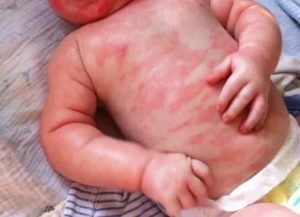 Аллергия у Ребенка 10 мес.