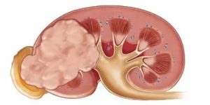 Объемное образование в почке