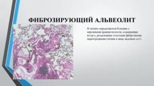 Фиброзирующий альвеолит. Может ли быть аллергия на преднизолон?