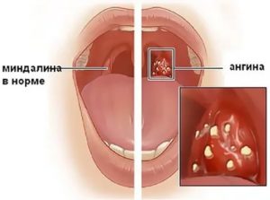 Пробки в миндалинах при беременности