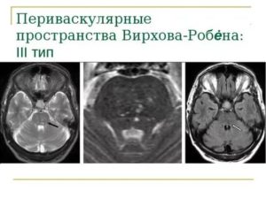 Периваскулярные пространства