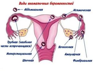 Могут ли идти месячные при беременности