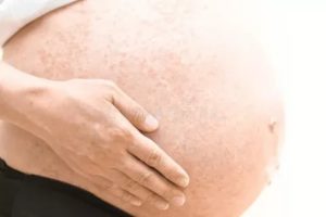 Нейродермит при беременности