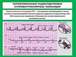 Тахикардия от тироксина, есть ли необходимость принимать постоянно