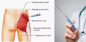 Жжение в ягодице после укола