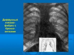 Пневмофиброз (?) у ребёнка