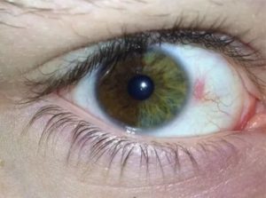 Красное пятно на белке глаза