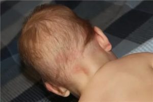 Сыпь на голове у ребенка