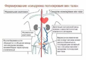 Варикоз малого таза. Боли