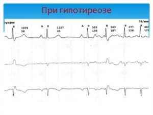 Тахикардия из за гипотиреоза