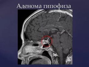 Расшифровка мрт гипофиза с контрастом