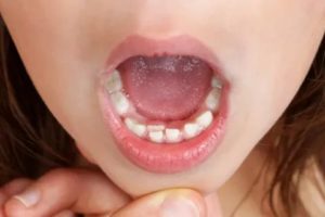 Коренной зуб вырос сзади молочного