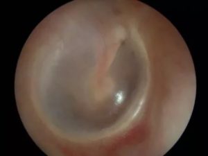 Обезболивание при перфорации перепонки уха