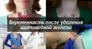 Резкое полнение и похудение после удаления щитовидной железы