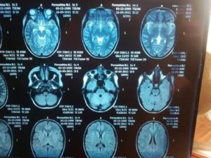 Расшифровка КТ головного мозга ребёнка
