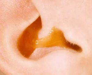 Каковы причины и функции желтого налета в ушах взрослого?