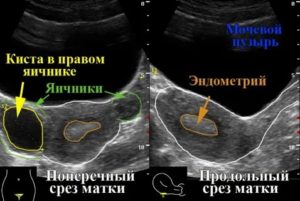 Узи маточной трубы расшифровка