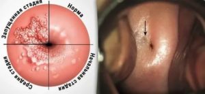 Болезни шейки матки