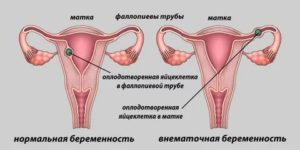 Могут ли идти месячные при беременности