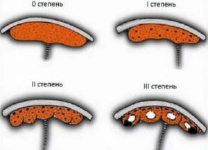 Старение плаценты